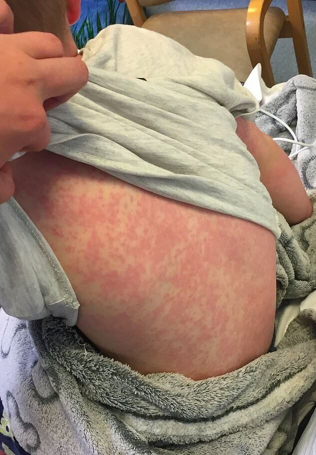 一个对冬天过敏的小男孩